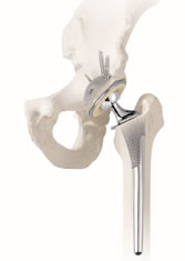 股関節について 人工股関節置換術・人工骨頭置換術｜もっと知りたい 